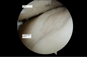 lloji i astroscope në gjurit me osteoarthritis e 3-të të shkallës