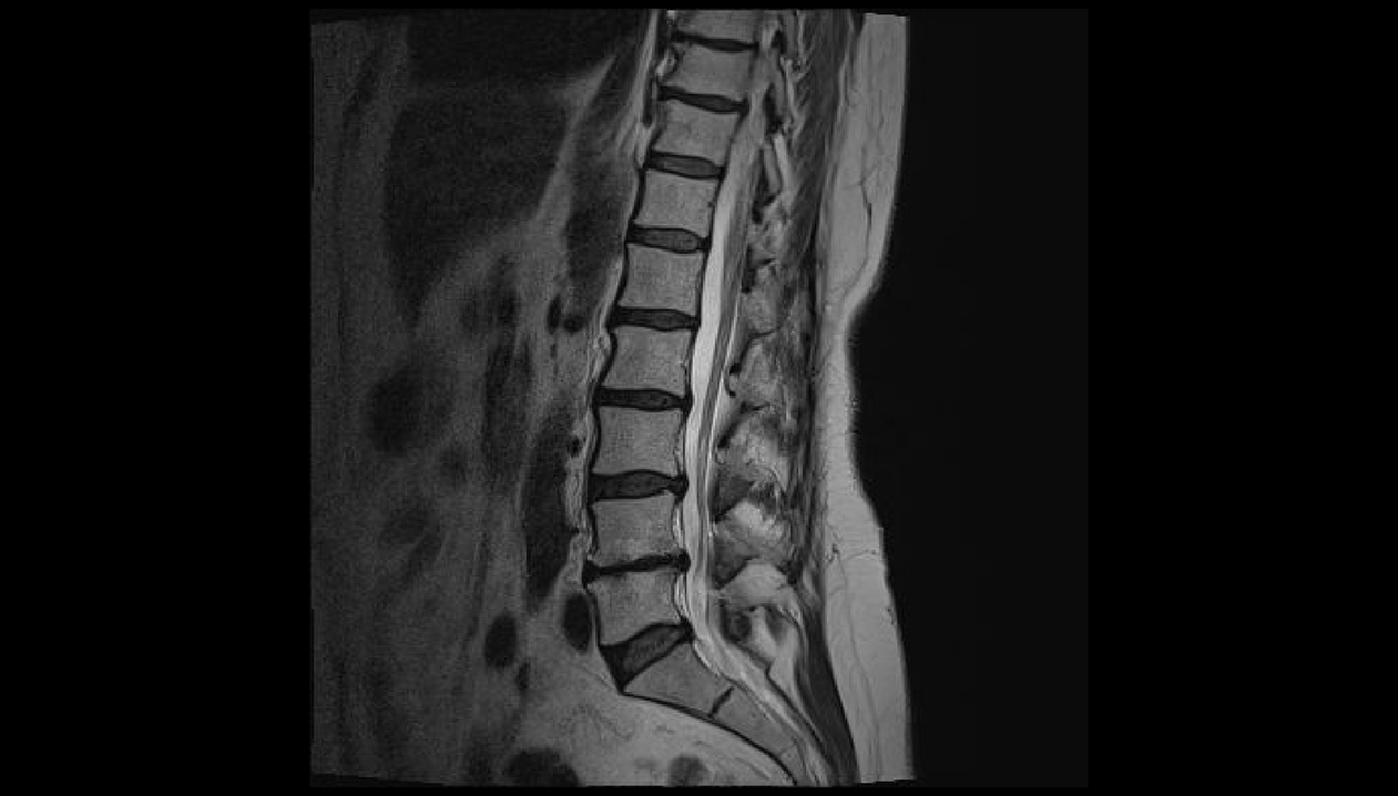 diagnoza e dhimbjes së shpinës në rajonin e mesit