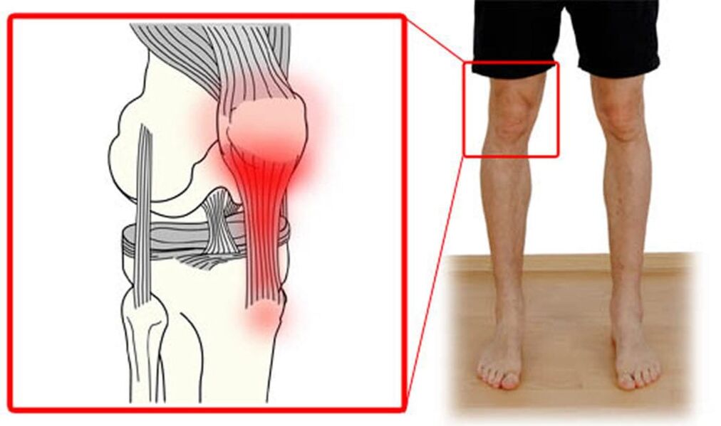 Tendinitis - inflamacion i tendinave në nyjen e gjurit