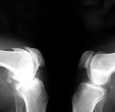 Osteoarthritis në x-ray