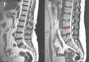 osteochondrosis të shtyllës kurrizore