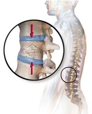 Osteoporoza provokon dhimbje shpine në rajonin e mesit